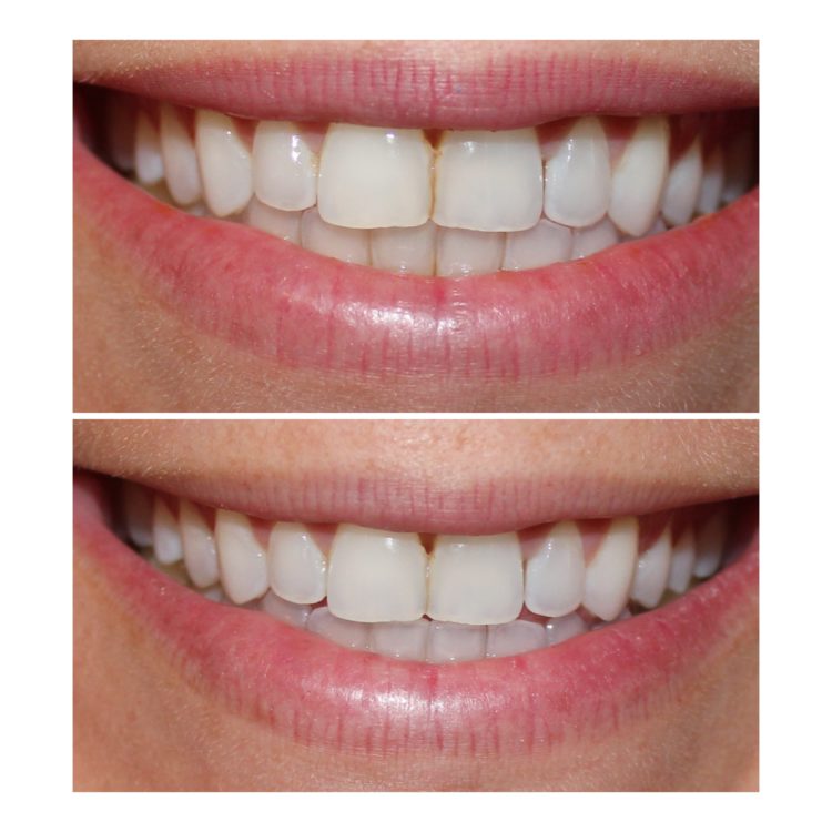 Let your smile shine this winter with teeth whitening trays from Smile Brilliant!