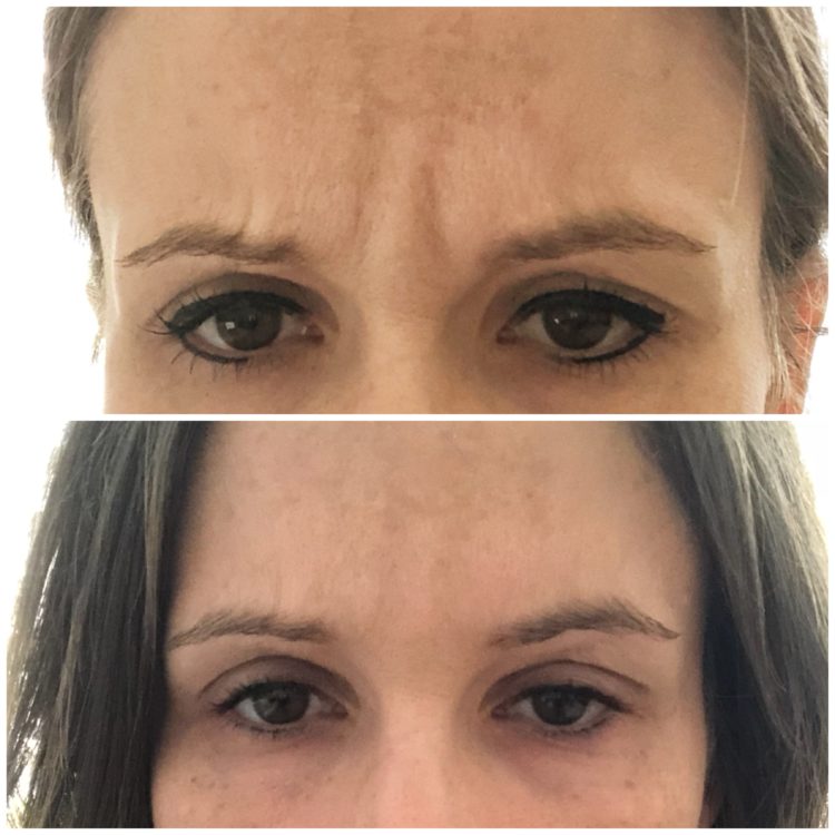 Botox is one of the best ways to prevent wrinkles. Today on the blog Dr. Molly Austin is guest posting and answering all of your questions about botox.